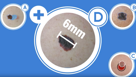 Akademia Czerniaka.Znamię! Znam je?