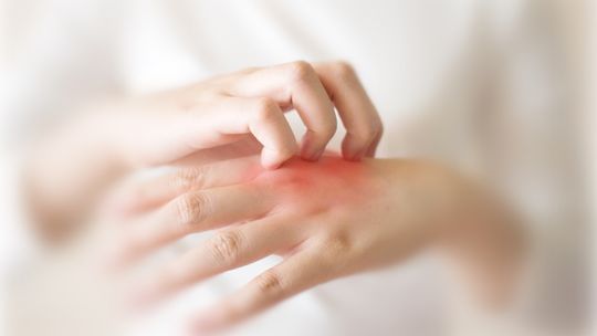 „Mamo, strasznie swędzą mi ręce !” Takie zdanie coraz częściej słyszą rodzice od dzieci powracających ze szkoły