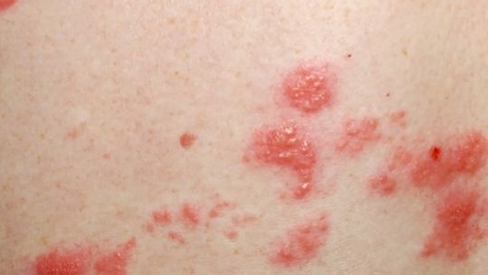 Zmiany skórne u pacjentów z COVID-19