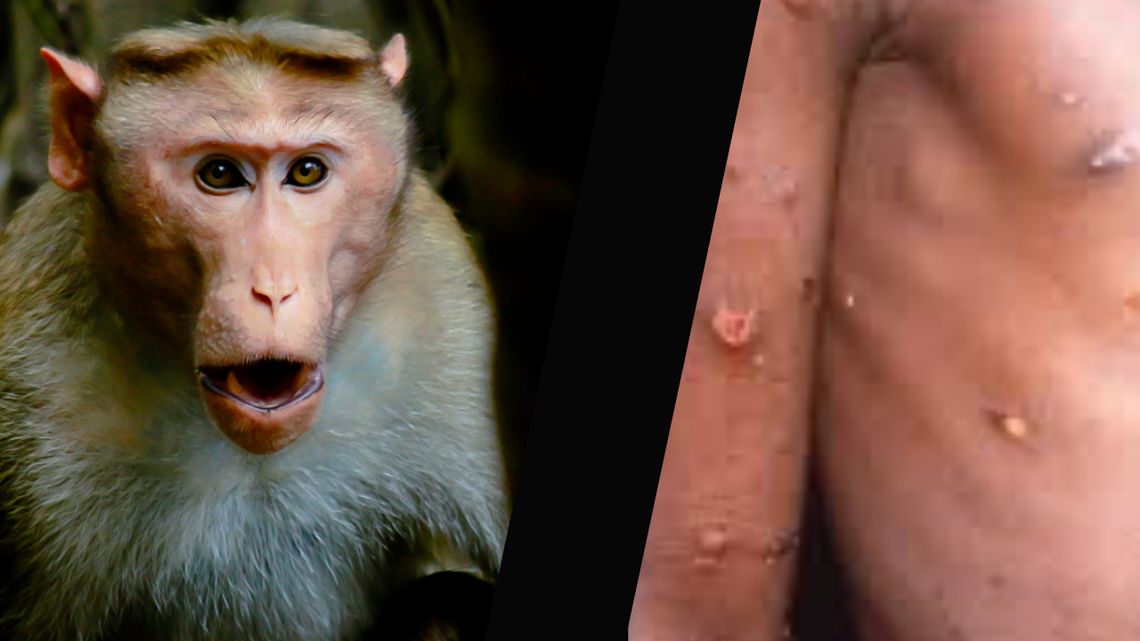Małpia ospa... Prawda kontra panika porno - dr Robert Malone